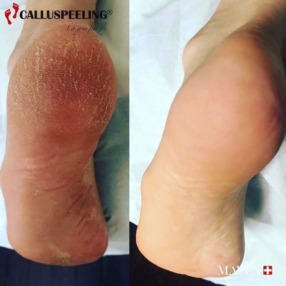 callus.e